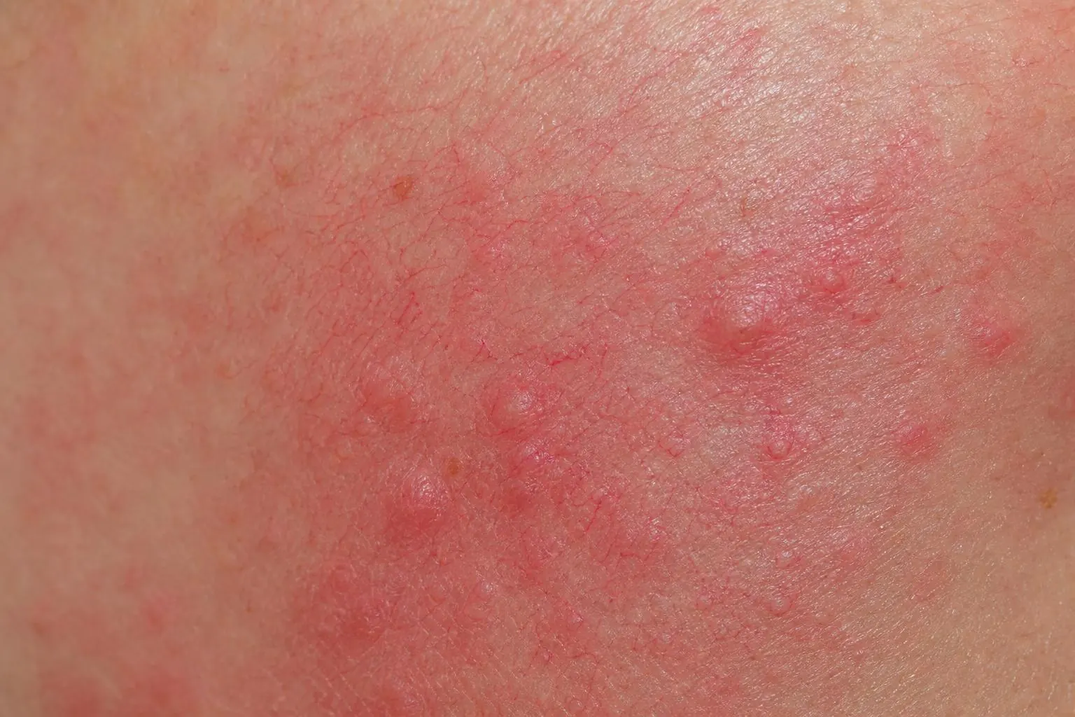 Rozacee